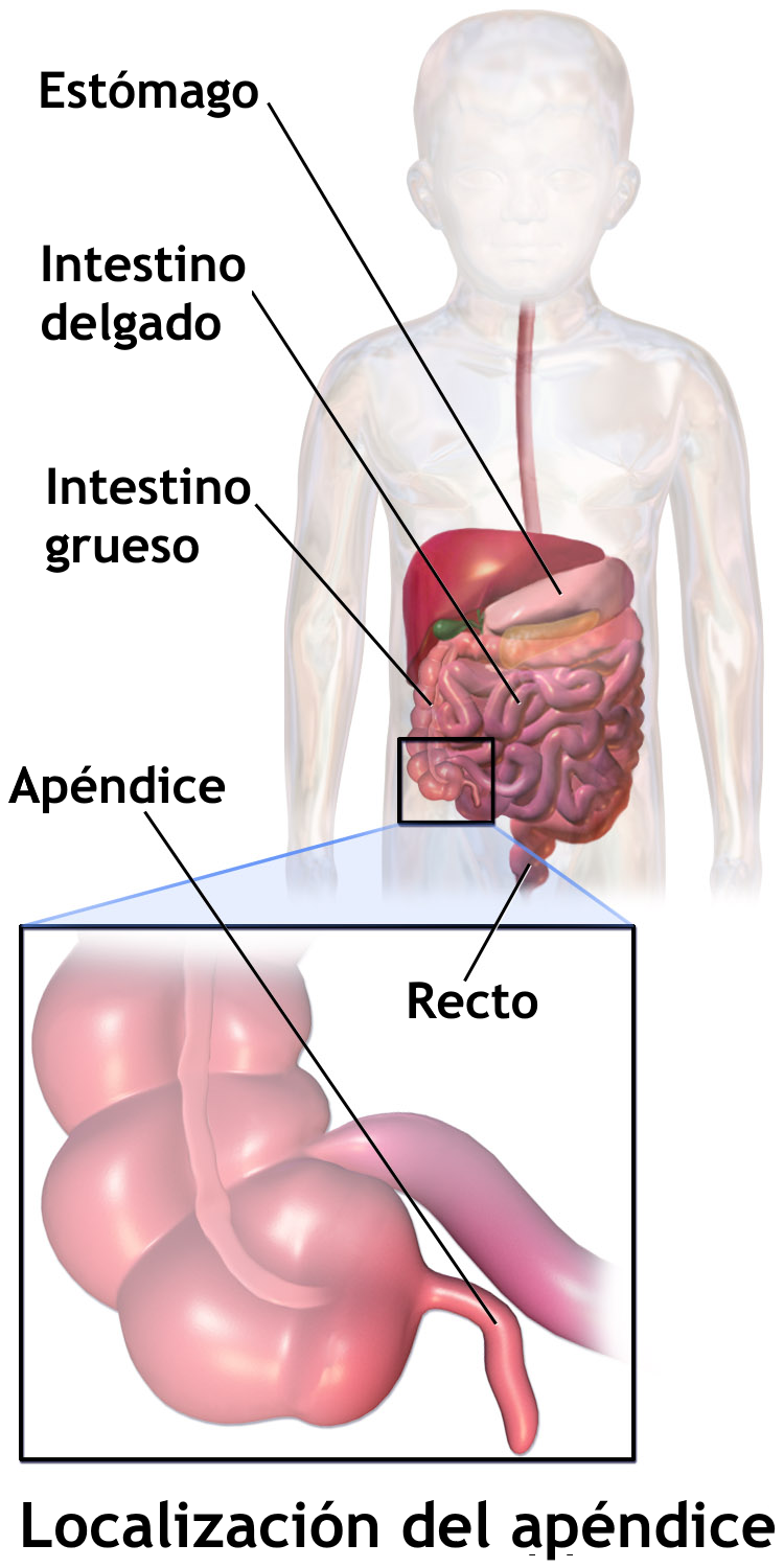 Diagrama del apéndice inflamado (apendicitis)