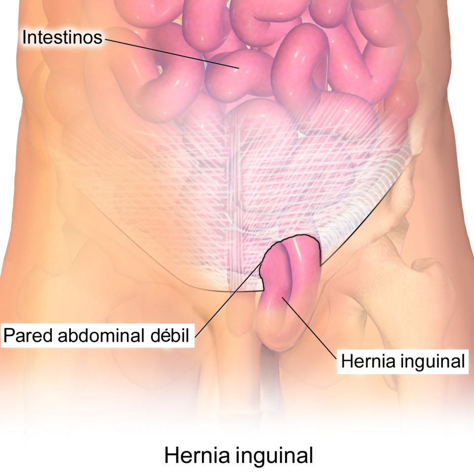 Diagrama de una hernia inguinal