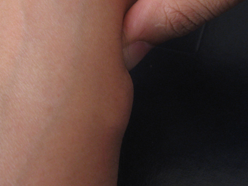Lipoma (tumoración grasa benigna) bajo la piel