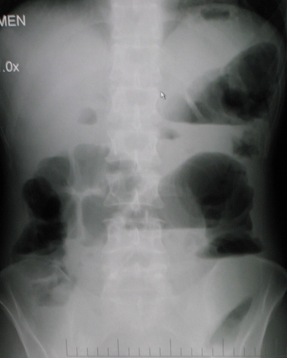 Radiografía de abdomen con obstrucción intestinal