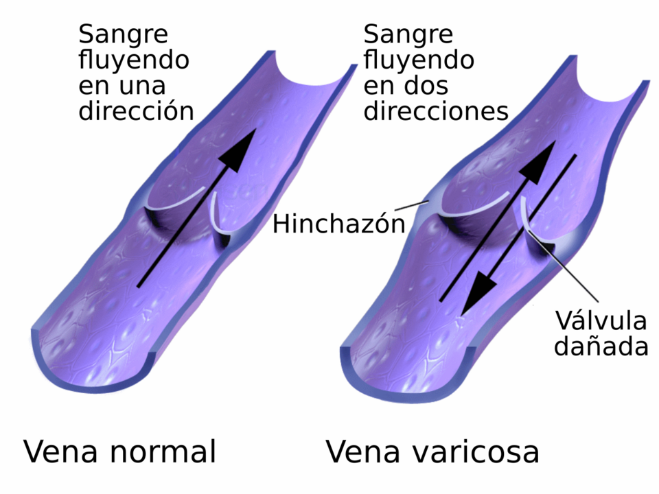 Diagrama de várices en la pierna